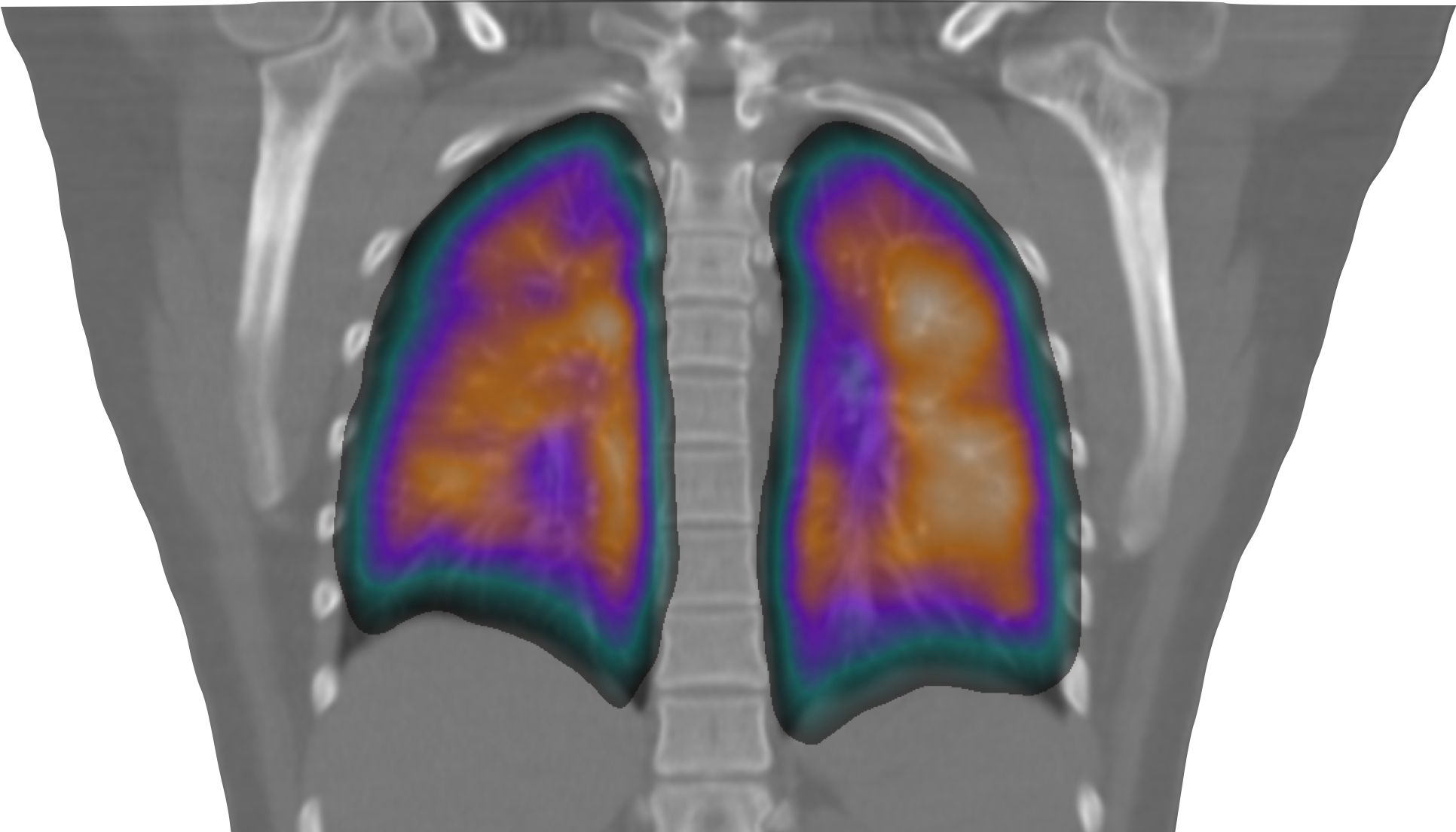 Lungenszintigraphie